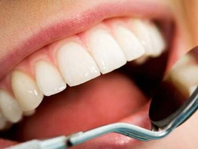 Caries Y Periodontitis Enfermedades Bucales Más Comunes 5879