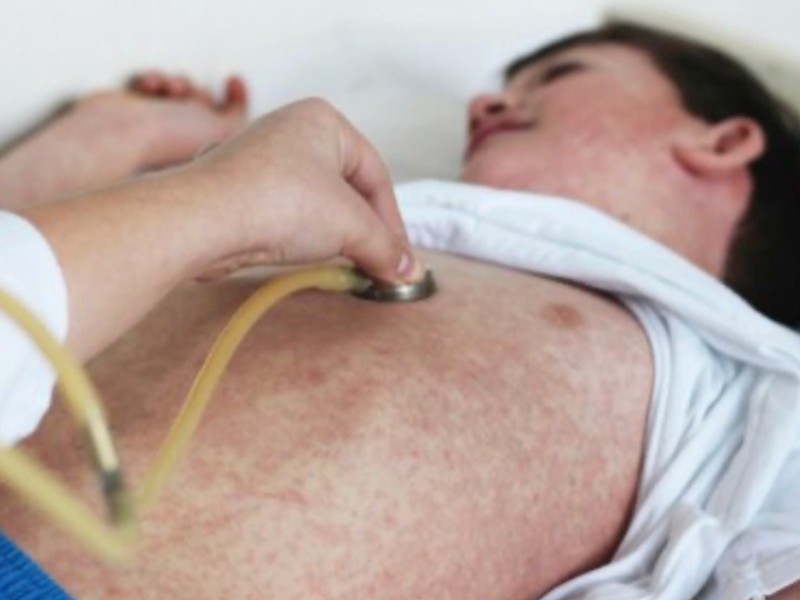 Padres deben verificar vacunación de sus hijos contra sarampión
