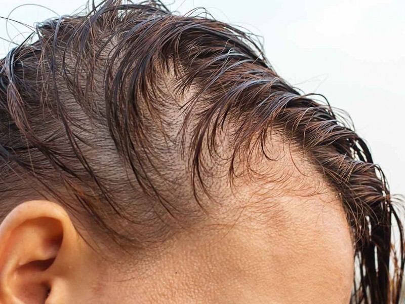 Remedios caseros retardan atención médica ante pérdida de pelo